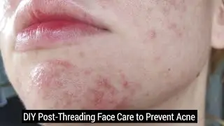 DIY Post-Threading Face Care to Prevent Acne Naturally | Acne Face Care