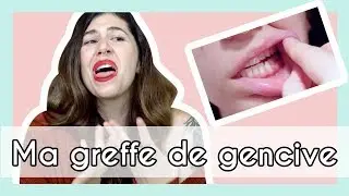 GREFFE DE GENCIVE 😷 &ndash; Mon exp&eacute;rience