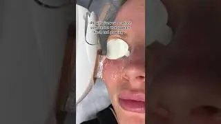 IPL is a game changer for Rosacea and hyperpigmentation! #shorts #hyperpigmentation #rosacea
