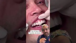 FACETTES pelliculaires : une fa&ccedil;on ULTRA-FINE d&rsquo;embellir le sourire ?