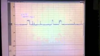 BKCa Single channel recording