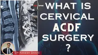 Cervical ACDF Surgery Explained