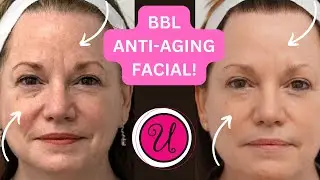 Top Arizona Med Spa Talks About BBL Laser Skin Treatment!￼