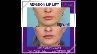 Revision Lip Lift
