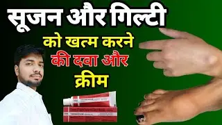 Swelling को कम करने की क्रीम | Thrombophob ointment | Swelling Treatment