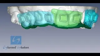 Art behind transfer tray in digital indirect bonding