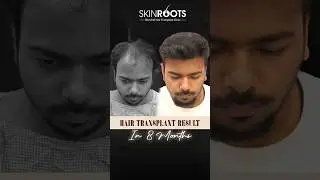 Hair Transplant 12 Month Results | Grade 5 Baldness Before & After Transformation | Skinroots Clinic