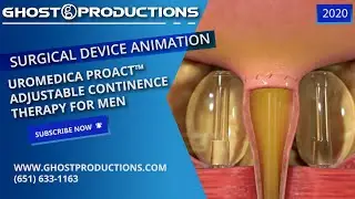 Medical Animation: Medical Device - Uromedica ProACT&trade;  Adjustable Continence Therapy for Men