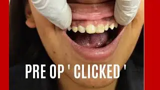 Dental Veneers #veneers #smilemakeover  #dentalscanner #smiledesign #smiledesigning