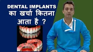 DENTAL IMPLANT का खर्चा कितना होता है ? EXPLAINED BY DR ROHAN VIRANI
