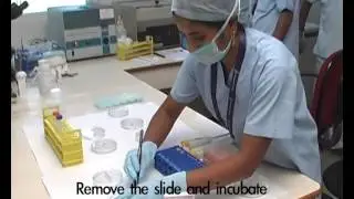 Krishna IVF Clinic | Sperm chromatin Dispersion Technique