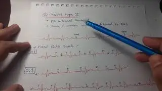 Clinical ECG Interpretation in Bangla (Part-2) : Heart blocks by @dr.md.ismailhossain1269