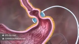 Gastric Band | Digestive System Animation