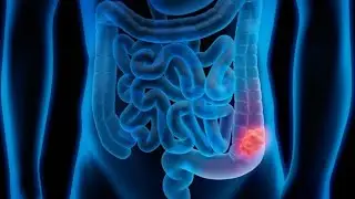 Colorectal Cancer Modern Treatment Options Explained