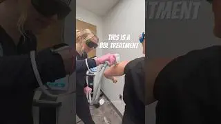 BBL (BroadBand Light) treatment! #lasertreatment #laserskintreatment #skincareroutine #antiaging