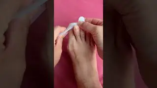 #ToeSeparator #OverlapToe #Ballux#footcare