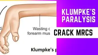 klumpke palsy MRCS question solve (CRACK MRCS)