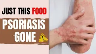 Scalp Psoriasis Gone With This Anti-inflammatory Breakfast Diet
