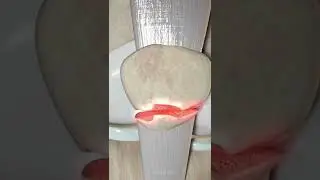 Lower pole patella fracture