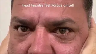 ACUTE LEFT VESTIBULAR NEURITIS