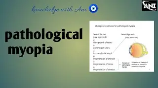 pathological myopia || ophthalmology || AK khurana ophthalmology #knowledgewithani