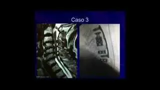 Mielopatía Espondilótica Cervical