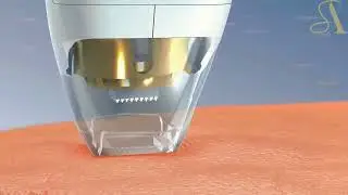SA-RV04 Tixel fraxel stretch marks removal machine