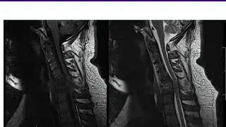 Spine Infections - ABOS Orthopedic Surgery Board Exam Review