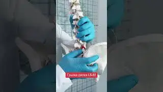 Межпозвоночная грыжа L5-S1 диска