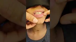 Caso tratado com 2 extrações de dentes superiores, 1 ano de pós concluído