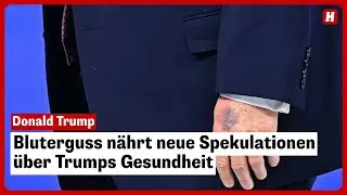 Bluterguss nährt neue Spekulationen über Trumps Gesundheit