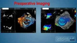 CVI 2019_Saturday, 7/20_ The Boundaries of Structural Heart Therapy III _Brinder Kanda, MD