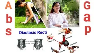 What is Diastasis Recti? How to start exercise after delivery?