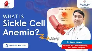 What Is Sickle Cell Anemia? Causes and Symptoms Explained | Dr. Meet Kumar #sicklecellanemia