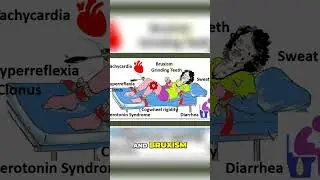 Serotonin-Syndrom: Ursachen, Symptome und Behandlung #shorts