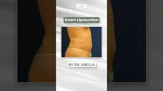 Smart Liposuction By Dr. Erella #SmartLipo