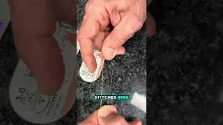 WILL MY STITCHES DISSOLVE?