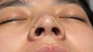 Dermatologist's Secret: Banish Blackheads FOR GOOD! 💥🔬