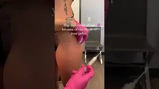 💉 SCULPTRA FOR HIP DIPS 💉