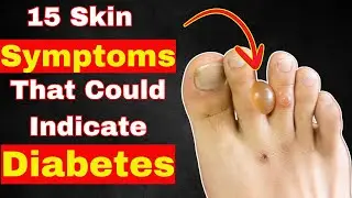 15 Skin Symptoms That Could Indicate Diabetes&mdash;Don't Ignore These!