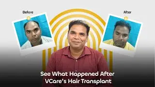 People Looked at My Bald Head &mdash; Now They Look at My Hairline! Hair Transplant GONE RIGHT
