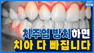 치주염, 잇몸에서 피날 때 이미 늦었을 수도 있습니다..!
