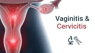 Vaginal discharge, Vulvovagival Burning and Itching,Vaginitis & Cervicitis explained
