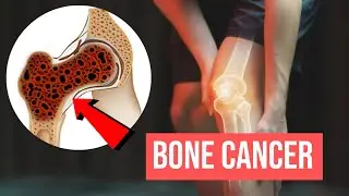 Bone Cancer Explained: Symptoms, Causes, Stages, and Treatment