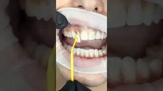 Colocar Facetas Dent&aacute;rias #dentistalisboa #dentalveneers #facetas