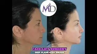 High Smass- Deep Plane Face Lift Surgery
