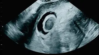 Chorionic Bump