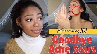 What You NEED to Know| Dermarolling/Microneedling