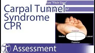 Wainner Clinical Prediction Rule (CPR) | Carpal Tunnel Syndrome (CTS)