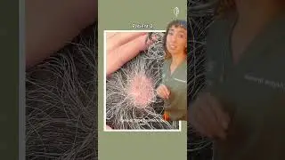 Before and After 1 Treatment for Alopecia Areata  Hair Loss